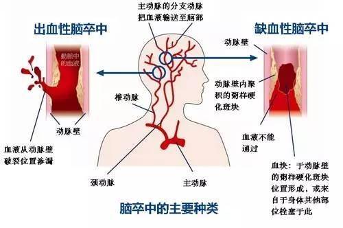 肺炎-呼吸训练器-基层肺功能-脑卒中-心血管病-中风-脑梗-慢阻肺-哮喘-呼吸肌-排痰-肺功能检测仪-赛客