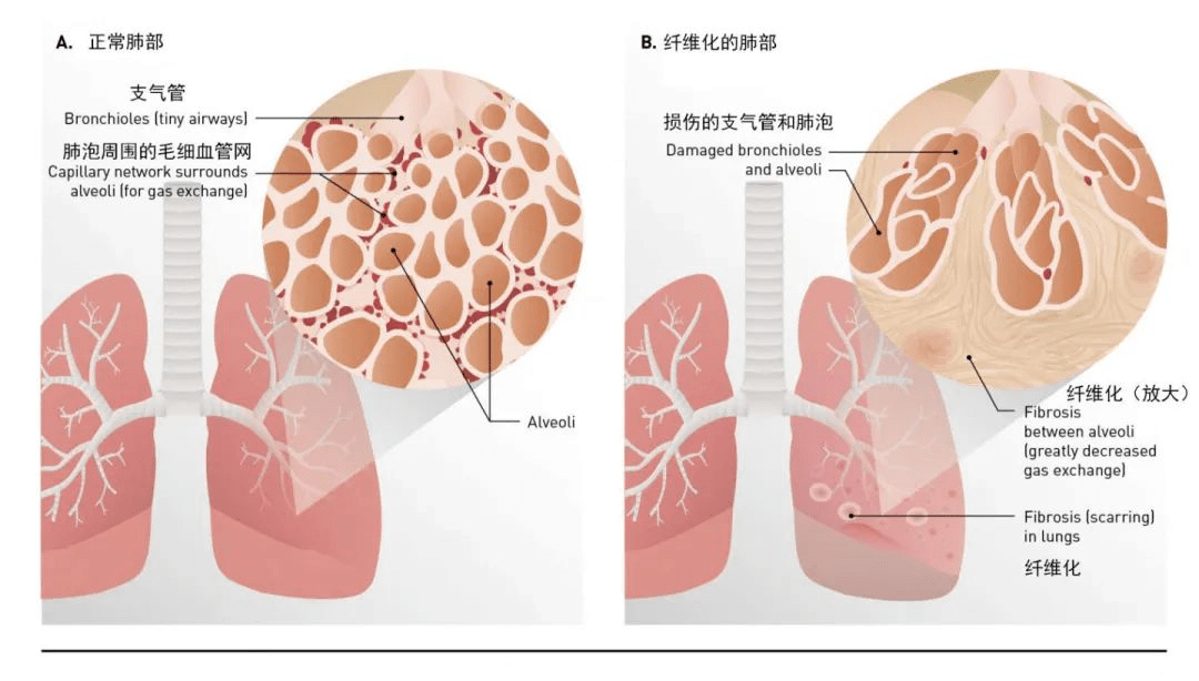 肺炎-呼吸训练器-基层肺功能-慢阻肺-哮喘-呼吸肌-排痰-肺功能检测仪-赛客-新冠-疫情-病毒-康复